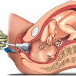 Forceps Delivery: Procedure, Indications, Risks, and Recovery” forceps delivery