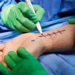 Hand Surgeon: Restoring Function and Mobility with Precision hand surgeon