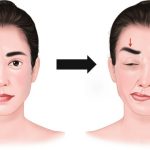 Demystifying Hemifacial Spasm: Causes, Symptoms, and Treatment Insights hemifacial spasm