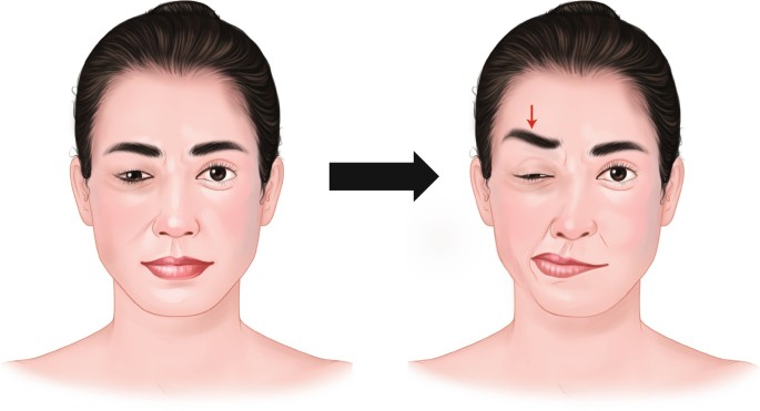 hemifacial spasm