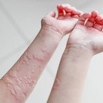 Managing Hives That Come and Go Daily: Causes, Treatment, and Prevention hives that come and go daily