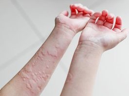 hives that come and go daily