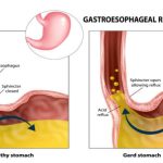Demystifying Heartburn: How Long Does Heartburn Last how long does heartburn last