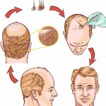 Exploring the Factors Influencing Hair Transplant Costs how much does a hair transplant cost