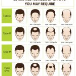 How Much Does Hair Transplant Cost? Exploring Factors, Options, and Budgeting how much does hair transplant cost