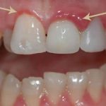 Natural Remedies: How to Cure Gum Disease Without a Dentist how to cure gum disease without a dentist