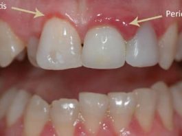 how to cure gum disease without a dentist
