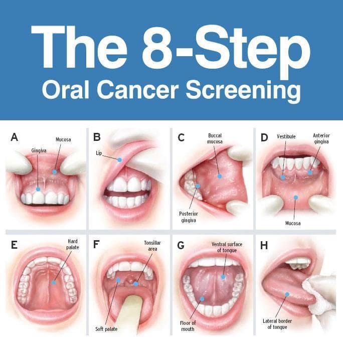 hpv throat cancer