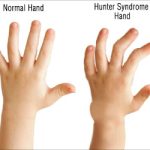 Hunter Syndrome: Unraveling the Genetics, Symptoms, and Treatments hunter syndrome