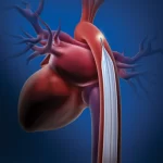 IABP: Intra-Aortic Balloon Pump in Cardiac Care – Benefits and Applications iabp