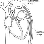 Intra Aortic Balloon Pump: An Essential Guide to Cardiac Support intra aortic balloon pump