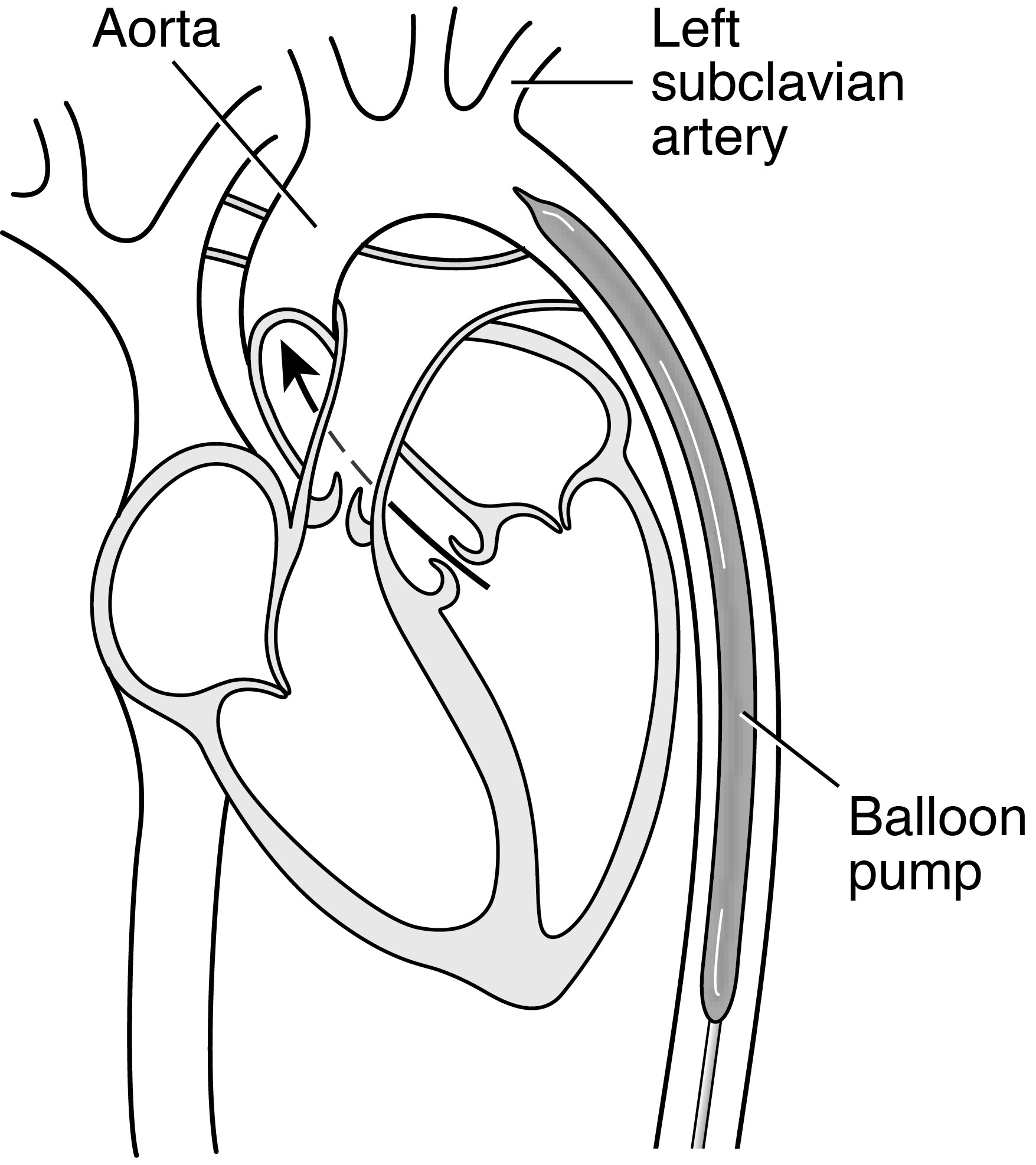 intra aortic balloon pump