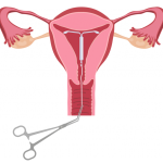 IUD Removal: A Comprehensive Guide to the Procedure and Aftercare iud removal