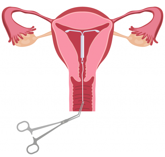 iud removal