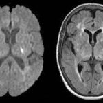 Demystifying Lacunar Infarct: Causes, Symptoms, and Management lacunar infarct