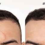 Laser Scar Removal: Reclaiming Skin Confidence laser scar removal