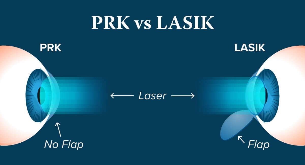 lasik vs prk