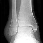 Understanding the Lateral Malleolus: Anatomy, Injuries, and Recovery lateral malleolus