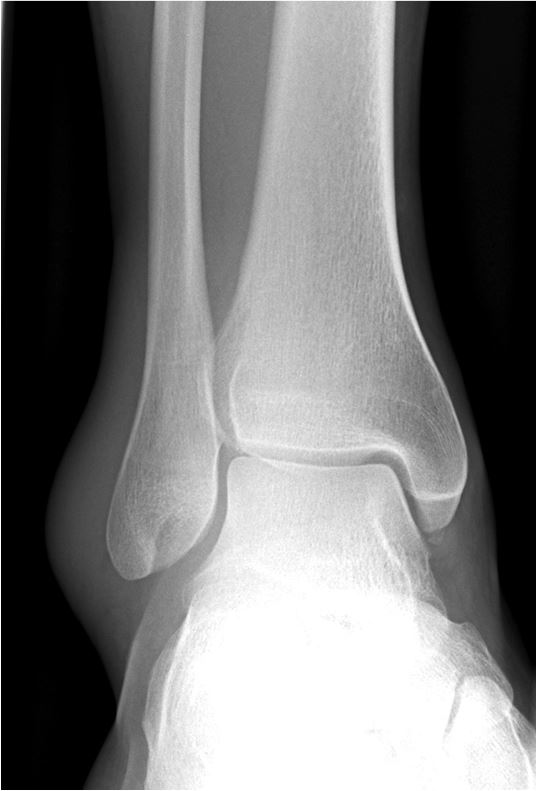 lateral malleolus