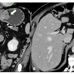 Leiomyosarcoma: Causes, Symptoms, and Treatment Options for this Rare Soft Tissue Cancer
