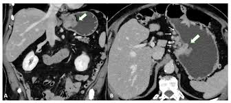 Leiomyosarcoma: Causes, Symptoms, and Treatment Options for this Rare Soft Tissue Cancer