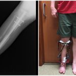 Standing Tall: Exploring the World of Limb Lengthening Surgery and Its Impact limb lengthening surgery