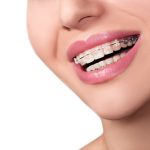 Unlocking Smiles: The Undeniable Benefits of Lingual Braces lingual braces