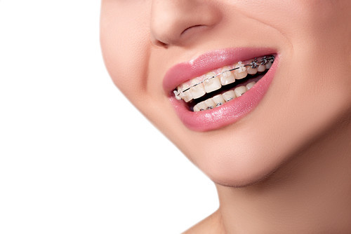 lingual braces