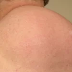Lipodystrophy Uncovered: Exploring Causes, Symptoms, and Treatment lipodystrophy