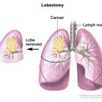 Understanding Lobectomy: Surgery, Recovery, and Life After lobectomy