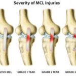 MCL Sprain: Causes, Symptoms, and Recovery mcl sprain