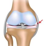 Exploring MCL Tear Symptoms: Recognizing Signs and Seeking Relief mcl tear symptoms