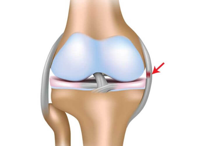 mcl tear symptoms