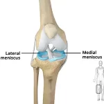 Mastering Meniscectomy: Procedure, Recovery, and Insights meniscectomy