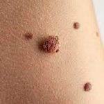 Metastatic Melanoma: Symptoms, Treatment, and Hope metastatic melanoma