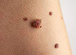 metastatic melanoma