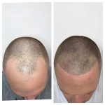 Enhance Your Beauty with Micropigmentation: A Comprehensive Guide micropigmentation