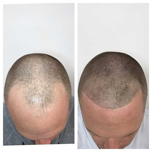 micropigmentation