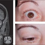 Miller Fisher Syndrome: Symptoms, Diagnosis, and Treatment miller fisher syndrome