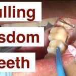 Loose Wisdom Tooth: Can I Pull It Out Safely? Expert Advice my wisdom tooth is loose can i pull it out