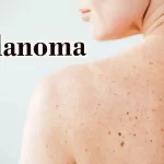 Nodular Melanoma: Causes, Symptoms, Diagnosis, and Treatment nodular melanoma