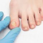 Onychogryphosis: Causes, Symptoms, Treatment onychogryphosis