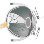 Comprehensive Guide to Optic Nerve Hypoplasia: Causes, Symptoms, and Management optic nerve hypoplasia
