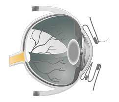 optic nerve hypoplasia