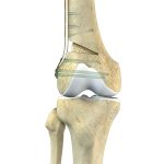 Osteotomy Surgery: Reshaping Your Path to Better Bone Health osteotomy