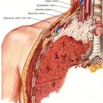 Pancoast Tumor: Symptoms, Diagnosis, and Treatment pancoast tumor