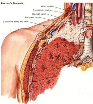 pancoast tumor