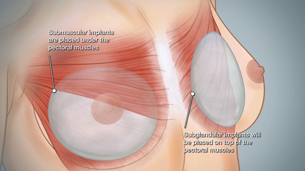 pectoral muscles after breast implant removal