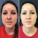 Revitalize Your Skin with Photofacial: The Ultimate Guide to Radiance photofacial