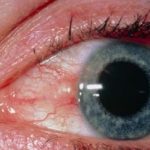 Pinguecula: Causes, Symptoms, and Treatment pinguecula